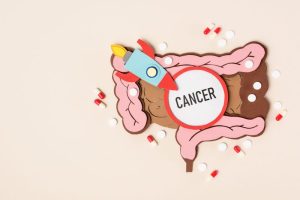 Lire la suite à propos de l’article Stadification du cancer du côlon