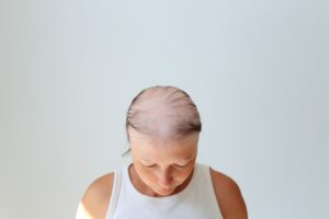 Lire la suite à propos de l’article 7 Solutions Douces pour Gérer la Chute des Cheveux après une Chimiothérapie