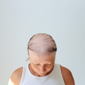 7 Solutions Douces pour Gérer la Chute des Cheveux après une Chimiothérapie
